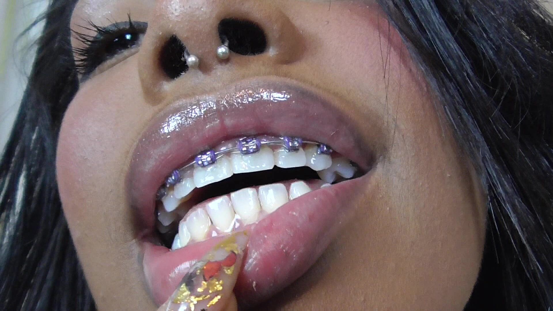 Black girl teeth brace fetish! –  – Solo Austria